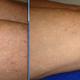 Illustration for article titled Why Consider Chicago Sclerotherapy Varicose Veins?em/em